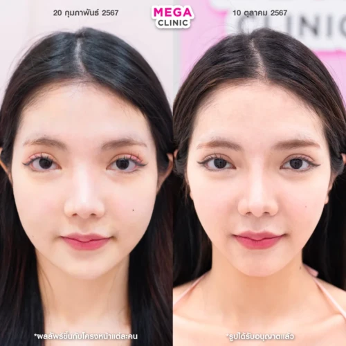 รีวิว โบท็อกกรามคู่กับแฟตสลายไขมัน