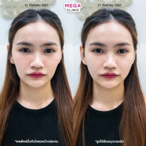 รีวิวฟิลเลอร์แก้มตอบ