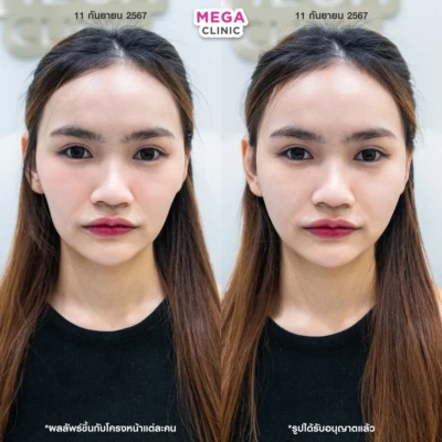 รีวิวฟิลเลอร์แก้มตอบ รีวิวฟิลเลอร์แก้มตอบ