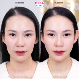 รีวิวฟิลเลอร์แก้มตอบ