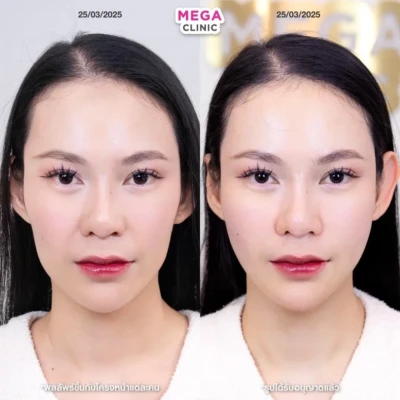 รีวิวฟิลเลอร์แก้มตอบ รีวิวฟิลเลอร์แก้มตอบ