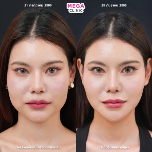 โบท็อกกราม ช่วยหน้าเรียว