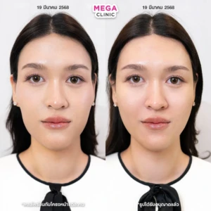 รีวิวฟิลเลอร์แก้มตอบ