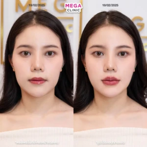 รีวิวฟิลเลอร์แก้มตอบ