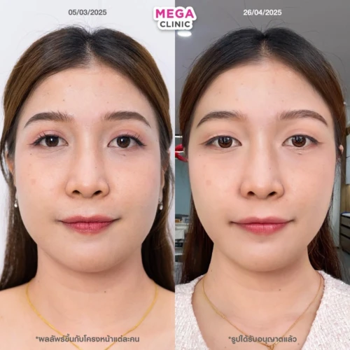 รีวิว ก่อน–หลัง ฉีดแฟตแก้ม ฉีดแฟตเหนียง