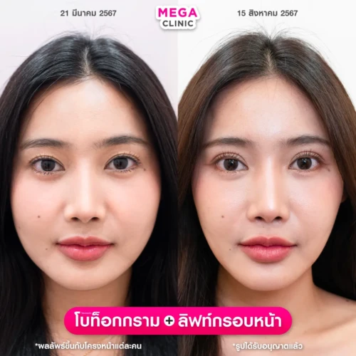 รีวิวฉีด โบลิฟกรอบหน้า คู่กับ โบกราม