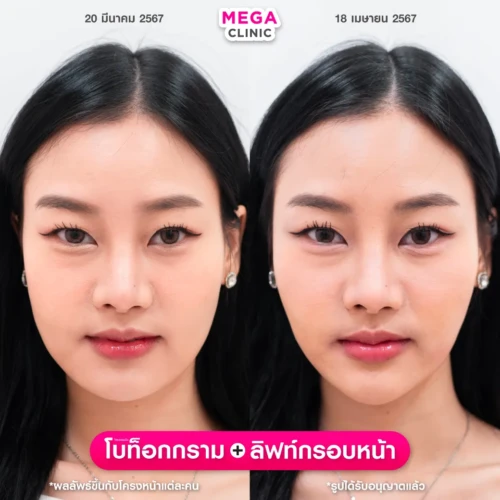 รีวิวฉีด โบลิฟกรอบหน้า คู่กับ โบกราม