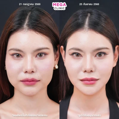 ฟิลเลอร์ร่องน้ำหมาก