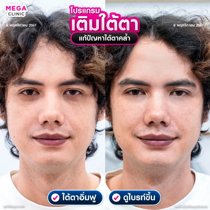 ฟิลเลอร์ใต้ตา