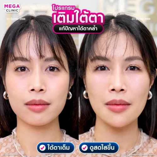 ฟิลเลอร์ใต้ตา