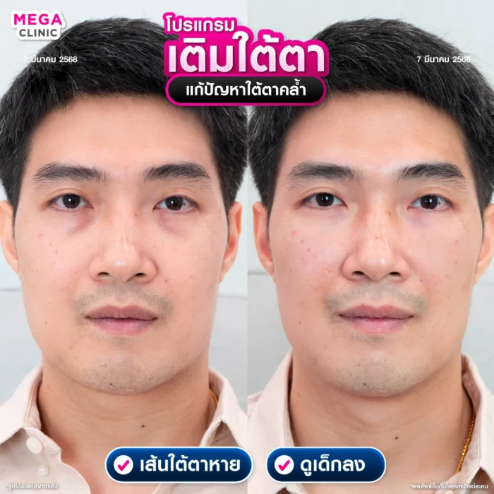 ฟิลเลอร์ใต้ตา