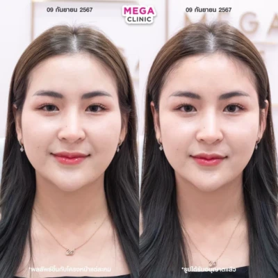 ฟิลเลอร์ขมับตอบ