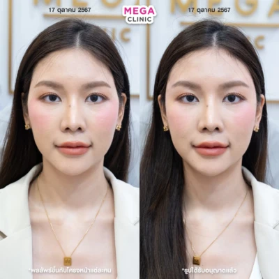 ฟิลเลอร์ขมับตอบ