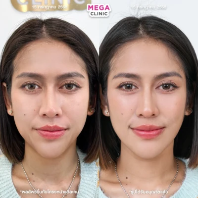 ฟิลเลอร์ร่องน้ำหมาก