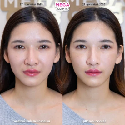 <span style="font-size:14px">填充剂法令纹</span>