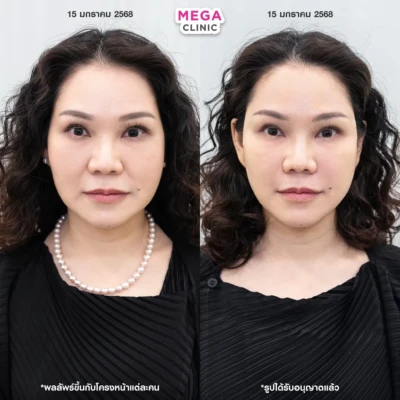 ฟิลเลอร์ร่องแก้ม