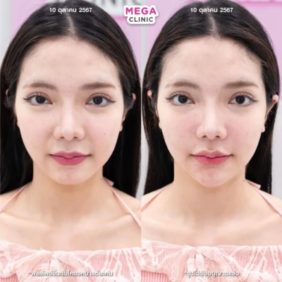 ฟิลเลอร์ร่องแก้ม