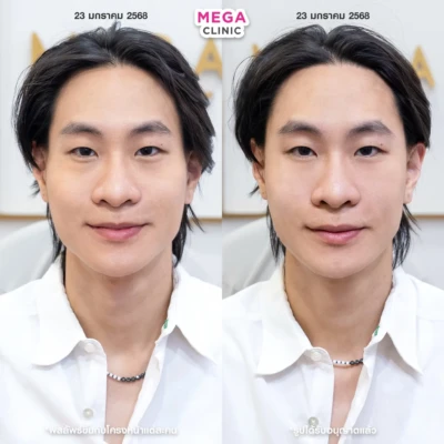 ฟิลเลอร์หน้าแก้ม