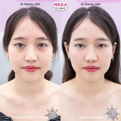 <span style="font-size:14px">玻尿酸填充泪沟</span>