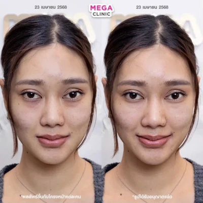 <span style="font-size:14px">玻尿酸填充泪沟</span>