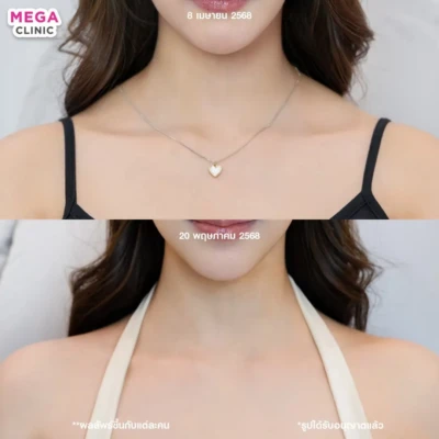 โบท้อกบ่าไหล