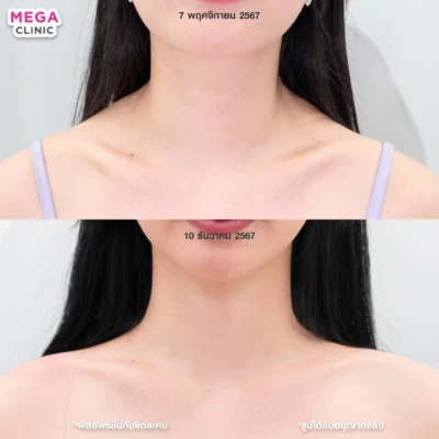 โบท้อกบ่าไหล