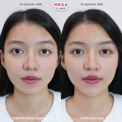 <span style="font-size:14px">下巴填充剂</span>