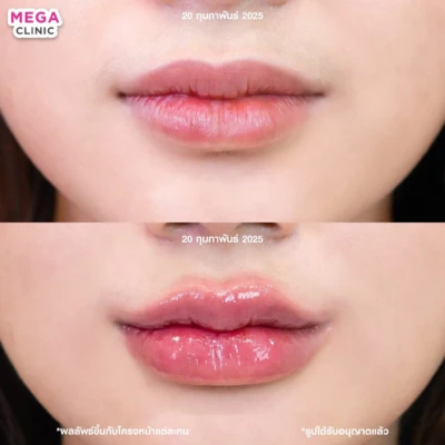 ฟิลเลอร์ปาก