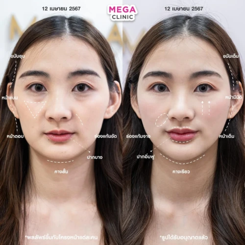 ฟิลเลอร์หลายบริเวณที่ MEGA CLINIC กรุงเทพ และปริมณฑล สยามสแควร์ เซ็นทรัลลาดพร้าว ฟิวเจอร์พาร์ค รังสิต เซ็นทรัลเวสต์เกต ปากน้ำ