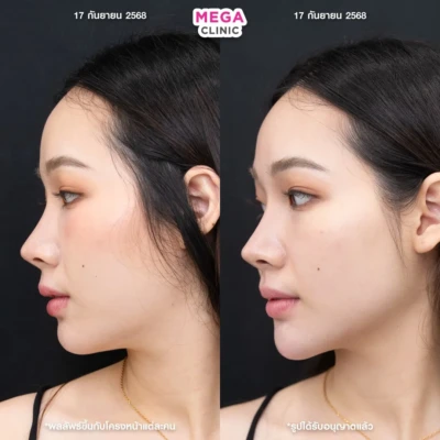 ฟิลเลอร์กราม MEGA CLINIC