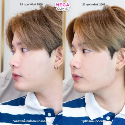 ฟิลเลอร์กราม MEGA CLINIC