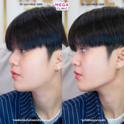 ฟิลเลอร์กราม MEGA CLINIC