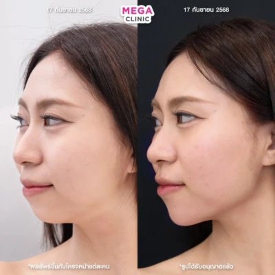 ฟิลเลอร์กราม MEGA CLINIC