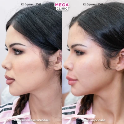 ฟิลเลอร์กราม MEGA CLINIC