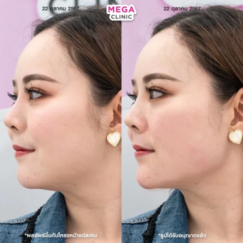 ฟิลเลอร์กราม MEGA CLINIC