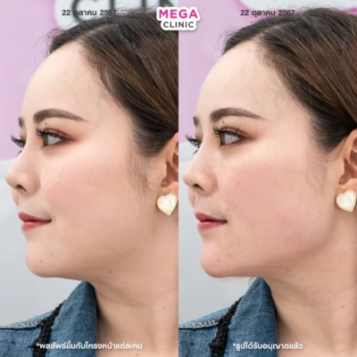 ฟิลเลอร์กราม MEGA CLINIC