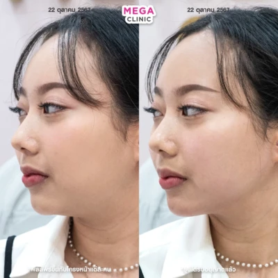 ฟิลเลอร์กราม MEGA CLINIC