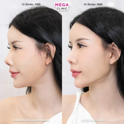 ฟิลเลอร์กราม MEGA CLINIC