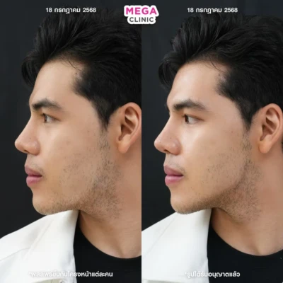 ฟิลเลอร์กราม MEGA CLINIC