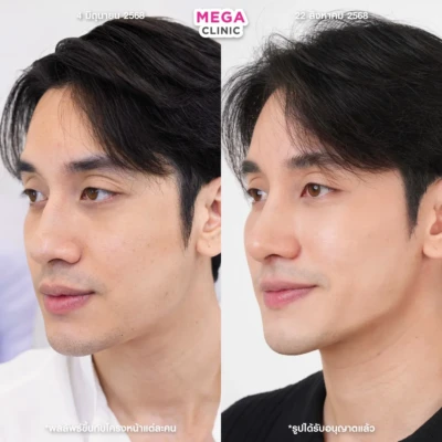 ฟิลเลอร์กราม MEGA CLINIC