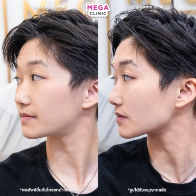 ฟิลเลอร์กราม MEGA CLINIC