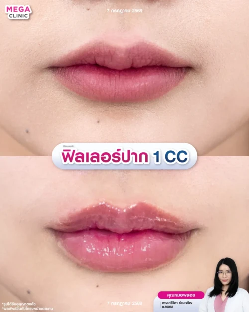 รีวิวฉีดปาก 1 CC