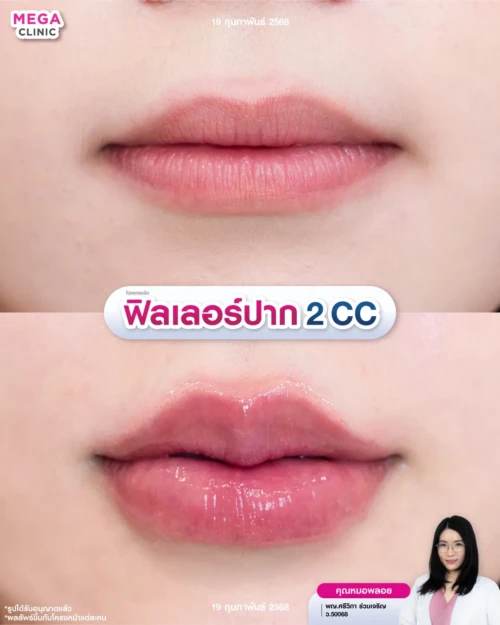 รีวิวฉีดปาก 2 CC