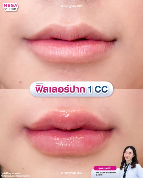 รีวิวฉีดปาก 1 CC