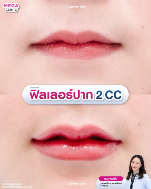 รีวิวฉีดปาก 2 CC