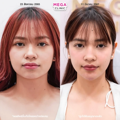 ฉีด ฟิลเลอร์คาง โบท็อกกราม ที่ไหนดี