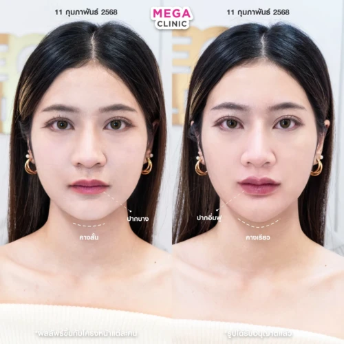 ฟิลเลอร์หลายบริเวณที่ MEGA CLINIC กรุงเทพ และปริมณฑล สยามสแควร์ เซ็นทรัลลาดพร้าว ฟิวเจอร์พาร์ค รังสิต เซ็นทรัลเวสต์เกต ปากน้ำ
