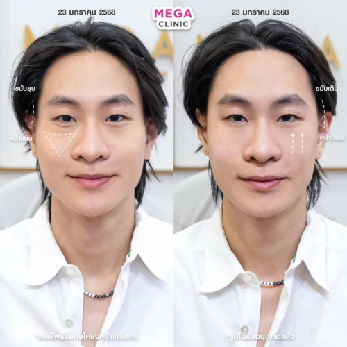 ฟิลเลอร์หลายบริเวณที่ MEGA CLINIC กรุงเทพ และปริมณฑล สยามสแควร์ เซ็นทรัลลาดพร้าว ฟิวเจอร์พาร์ค รังสิต เซ็นทรัลเวสต์เกต ปากน้ำ