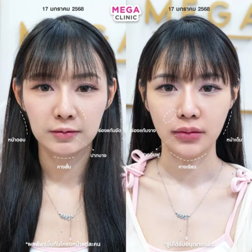 ฟิลเลอร์หลายบริเวณที่ MEGA CLINIC กรุงเทพ และปริมณฑล สยามสแควร์ เซ็นทรัลลาดพร้าว ฟิวเจอร์พาร์ค รังสิต เซ็นทรัลเวสต์เกต ปากน้ำ