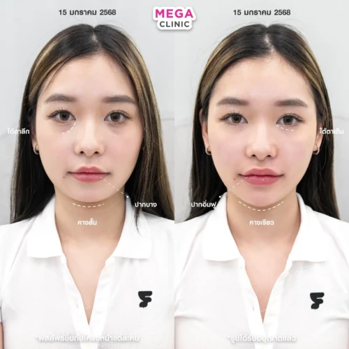 ฟิลเลอร์หลายบริเวณที่ MEGA CLINIC กรุงเทพ และปริมณฑล สยามสแควร์ เซ็นทรัลลาดพร้าว ฟิวเจอร์พาร์ค รังสิต เซ็นทรัลเวสต์เกต ปากน้ำ